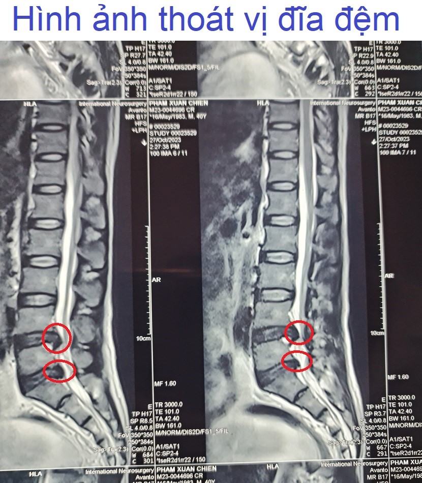 Hình ảnh thoát vị đĩa đệm 